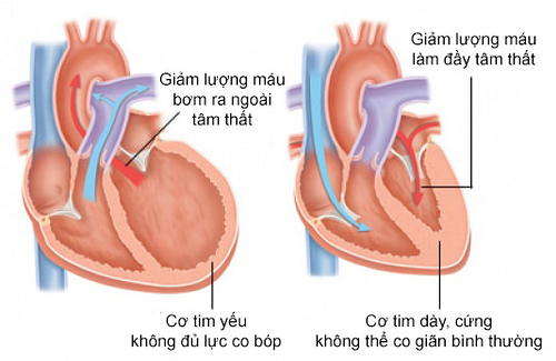 Triệu chứng của bệnh cao huyết áp