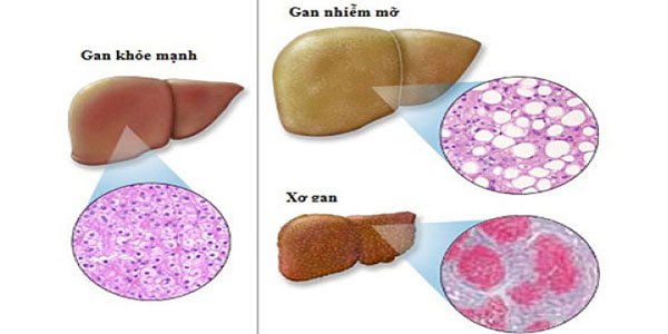 những cấp bệnh của gan nhiễm mỡ