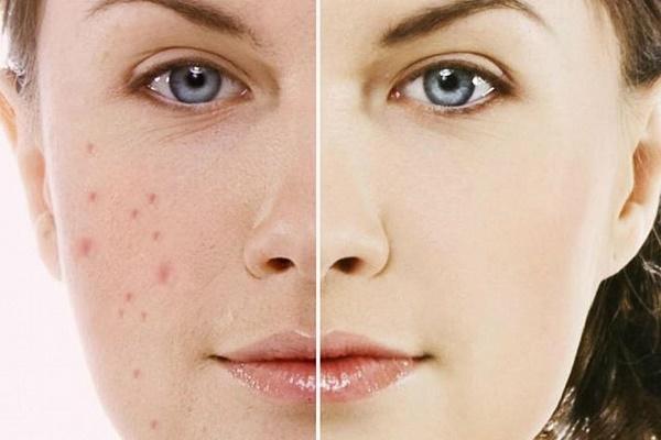 Điều trị sẹo hiệu quả
