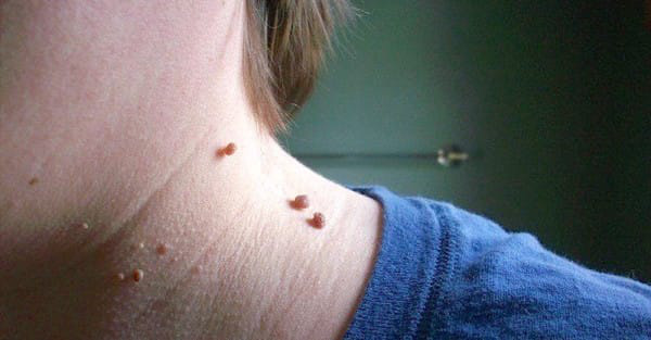 Sự hình thành và biểu hiện của mụn cóc