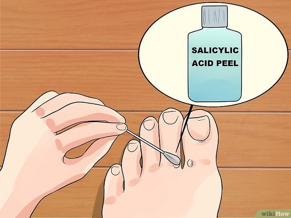 Trị mụn cóc bằng Acid Salicylic