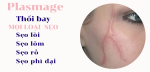XÓA SẸO CÁC LOẠI: 15 CÁCH TRỊ SẸO HÀNG ĐẦU MÀ BẠN NÊN BIẾT
