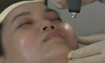 Công Nghệ Plasma Trong Thẩm Mỹ: Bước Tiến Vượt Trội Trong Tái Tạo Da