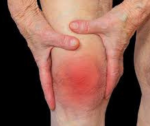 Bệnh viêm khớp dạng thấp - Cách điều trị và phục hồi 