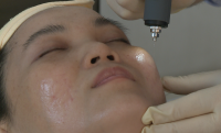 Công Nghệ Plasma Trong Thẩm Mỹ: Bước Tiến Vượt Trội Trong Tái Tạo Da