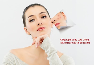 Nguyên nhân và cách điều trị sẹo lồi với công nghệ Lady Lipo Lifting